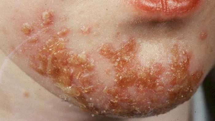 بیماری های تاول دار پوست