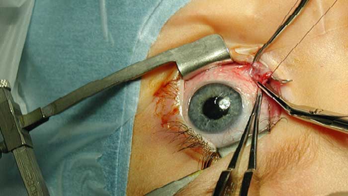 درمان انحراف چشم
