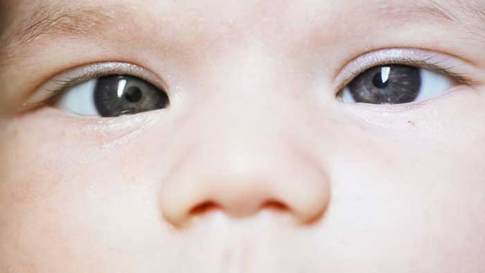 انحراف بینایی در نوزادان