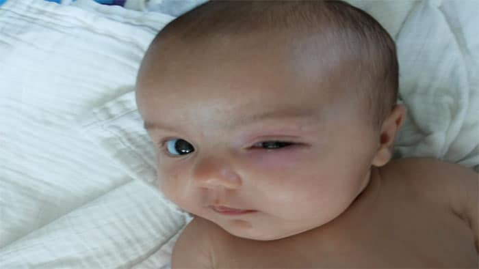 درمان عفونت چشم نوزاد