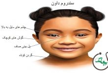 علائم جسمی سندروم داون