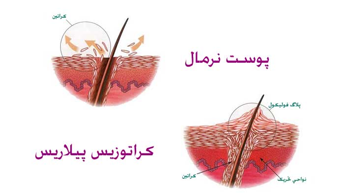 علت بیماری پوست مرغی