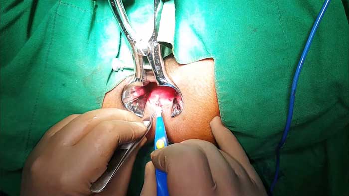 جراحی شقاق به روش اسفنکتروتومی