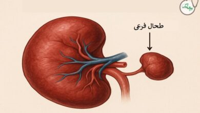 طحال فرعی
