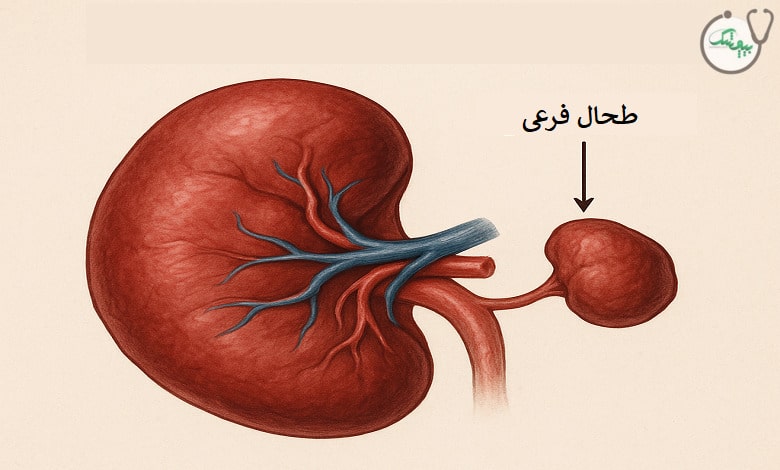 طحال فرعی