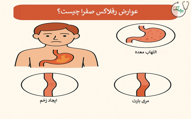 آیا رفلاکس صفرا خطرناک است