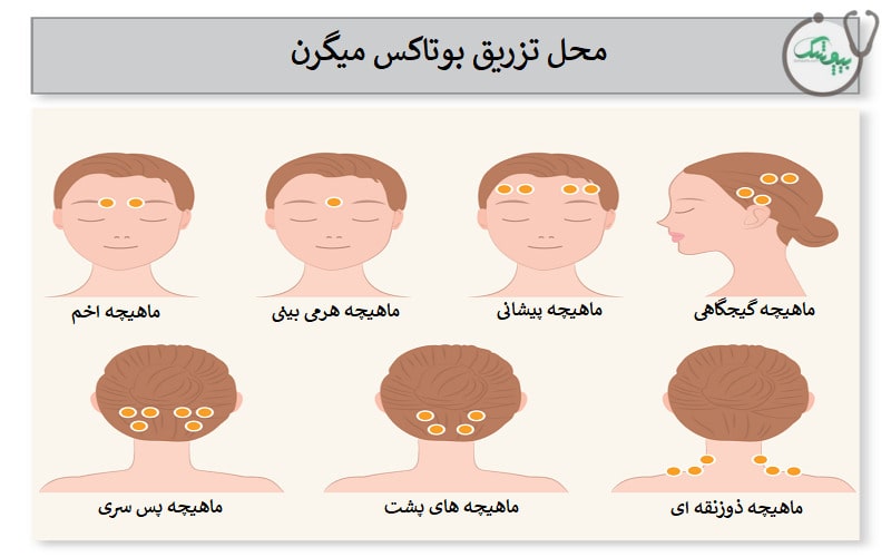 محل تزریق بوتاکس میگرن