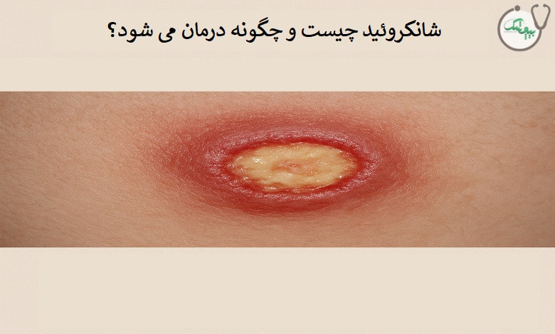 شانکروئید