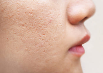 عکس اسکار فرورفته