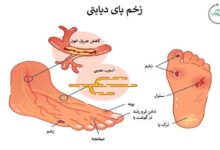 زخم پای دیابتی