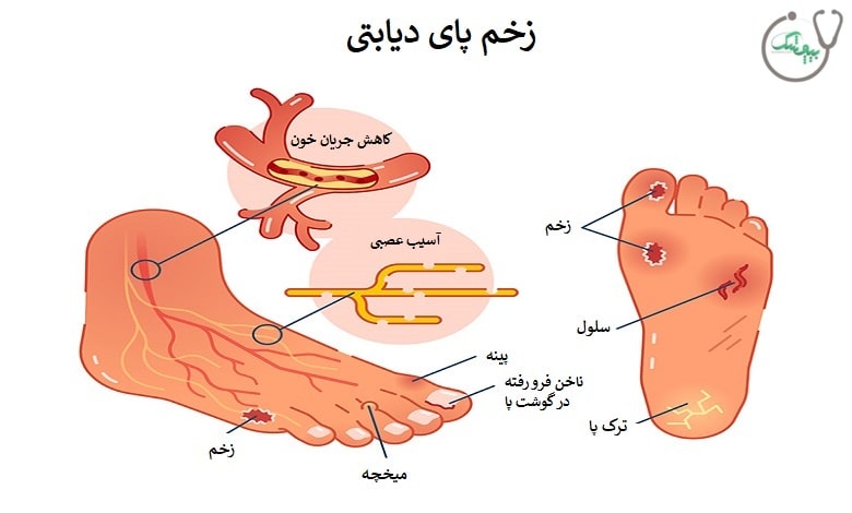 زخم پای دیابتی