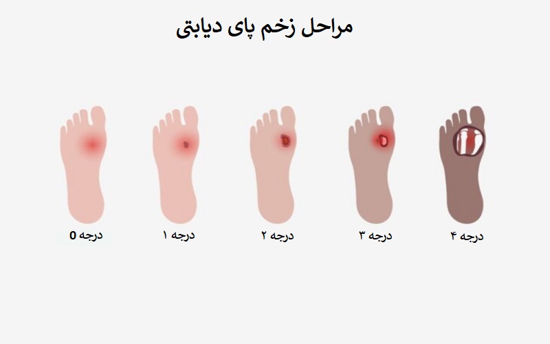 انواع زخم پای دیابتی