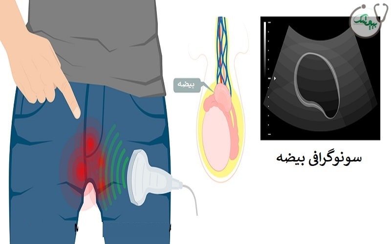 تشخیص عفونت بیضه