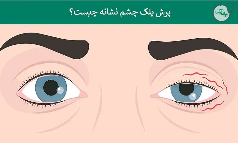 پرش پلک
