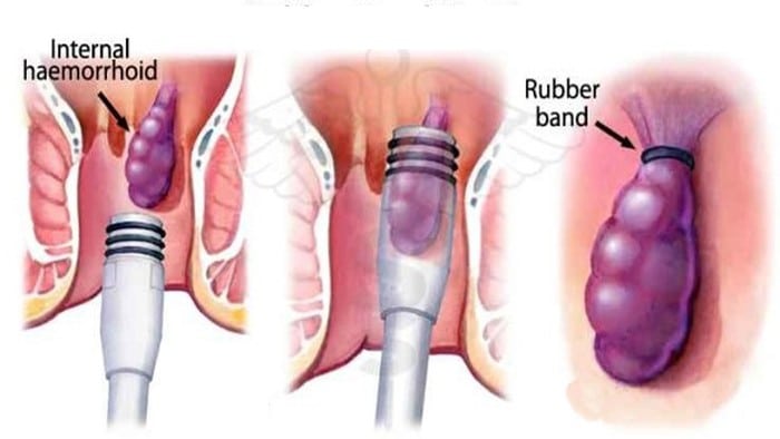 درمان بواسیر را رابربند یا کش لاستیکی