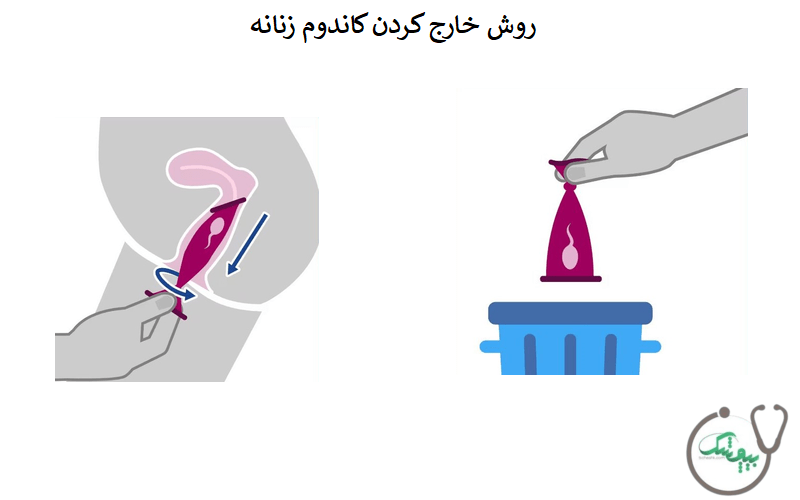 روش خارج کردن کاندوم زنانه