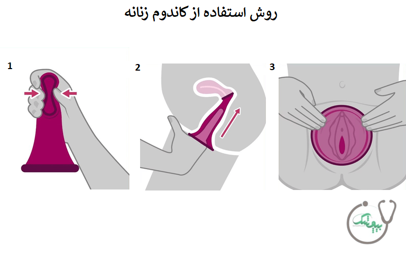 روش استفاده از کاندوم زنانه