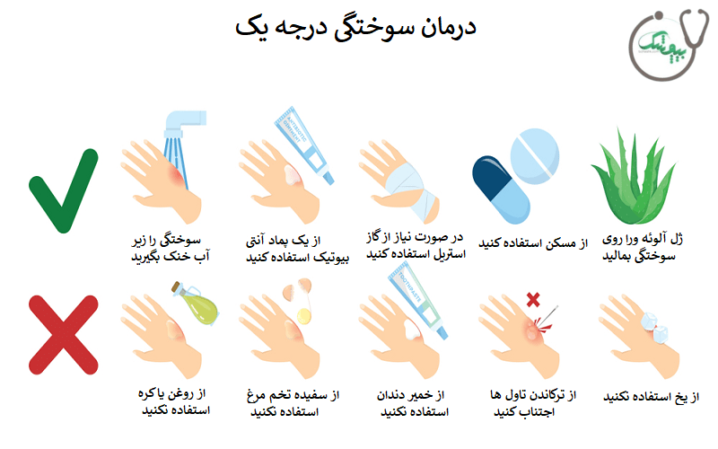 درمان سوختگی درجه یک