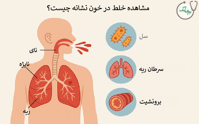 خلط خونی نشانه چیست