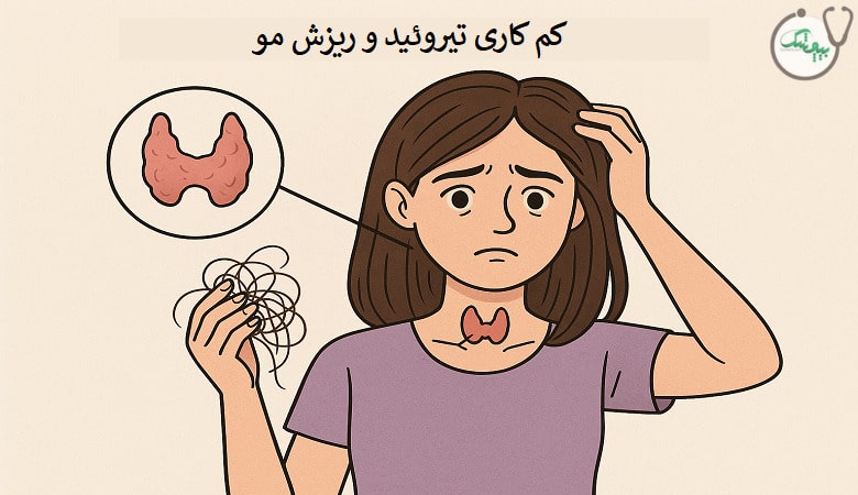 کم کاری تیروئید و ریزش مو