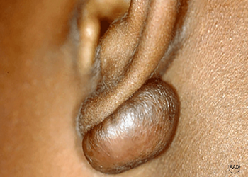 عکس اسکار کلوئید