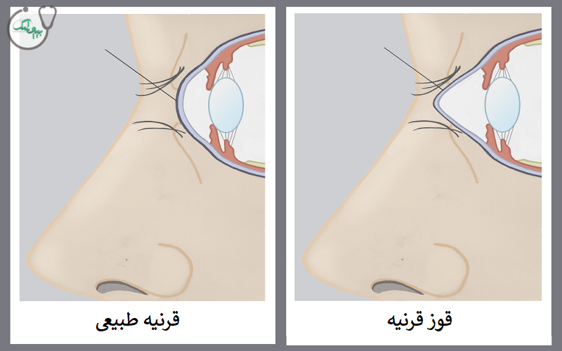 قوز قرنیه چیست
