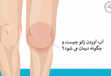 آب آوردن زانو