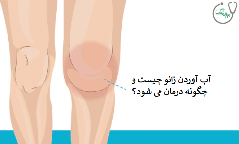 آب آوردن زانو