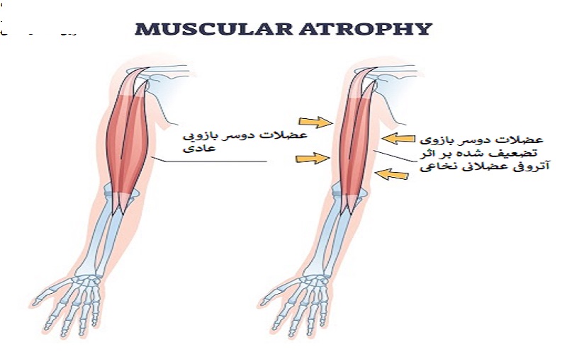 تاثیر آتروفی عضلانی نخاعی بر عضلات
