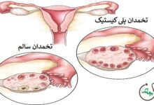 سندرم تخمدان پلی کیستیک