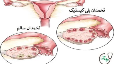 سندرم تخمدان پلی کیستیک