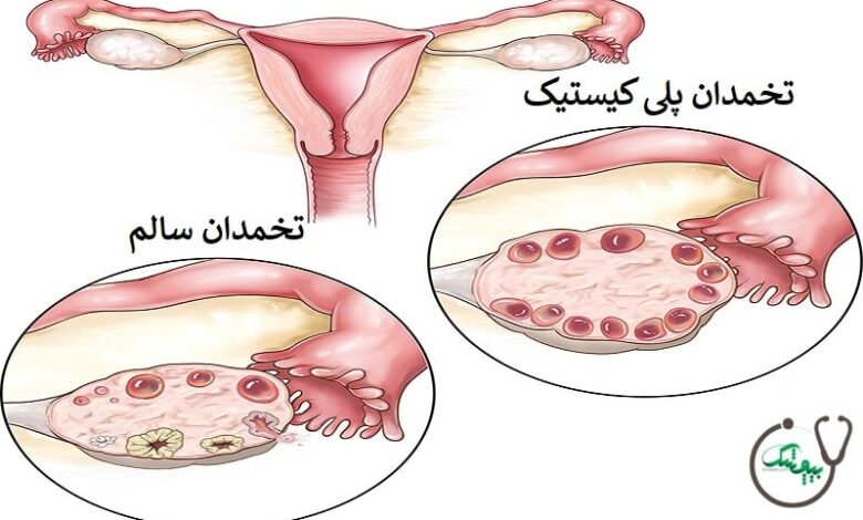 سندرم تخمدان پلی کیستیک