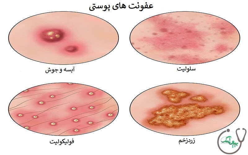 انواع عفونت پوستی