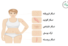 اسکار پوست