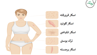 اسکار پوست
