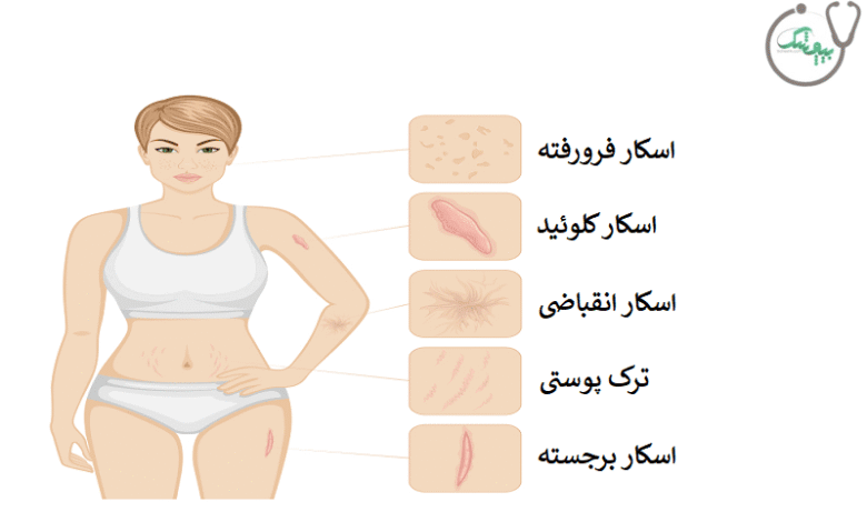 اسکار پوست