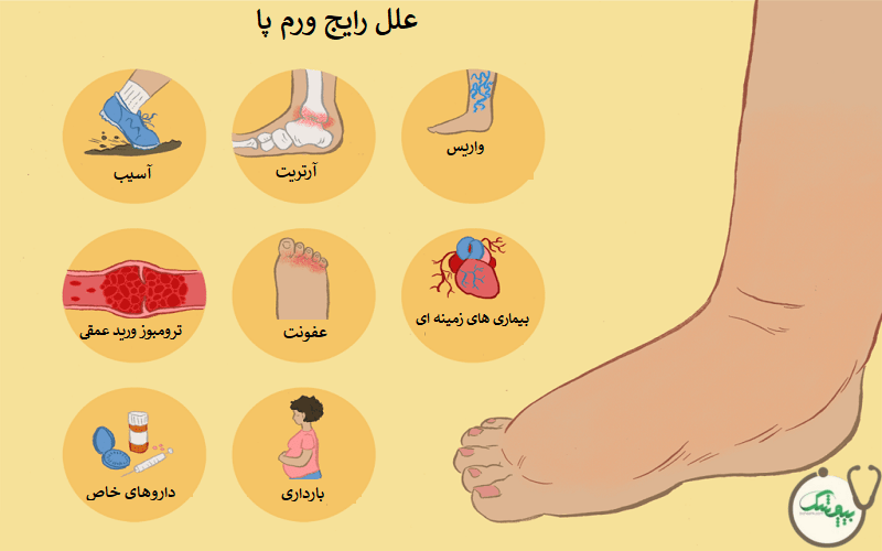 ورم پا نشانه چیست