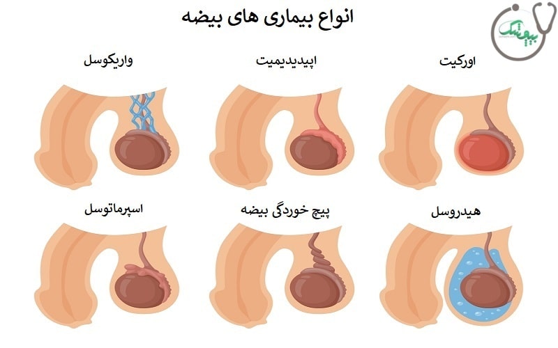 انواع بیماری بیضه