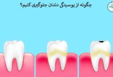 چگونه از پوسیدگی دندان جلوگیری کنیم