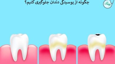 چگونه از پوسیدگی دندان جلوگیری کنیم
