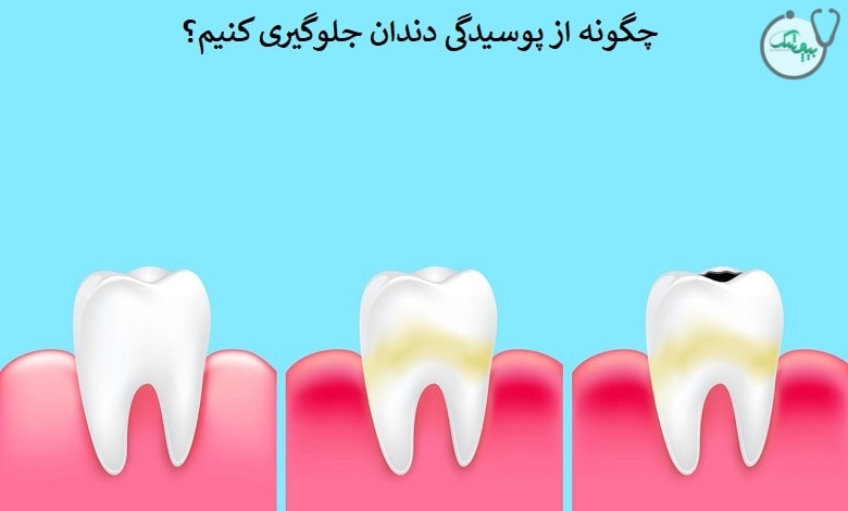 چگونه از پوسیدگی دندان جلوگیری کنیم