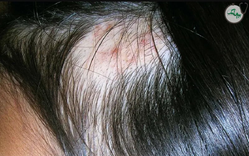 عوارض کندن موی سر از ریشه
