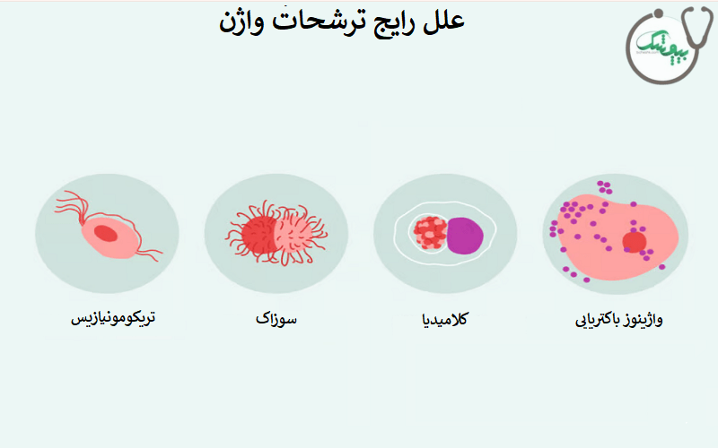 علت ترشحات واژن