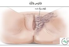 واریس واژن