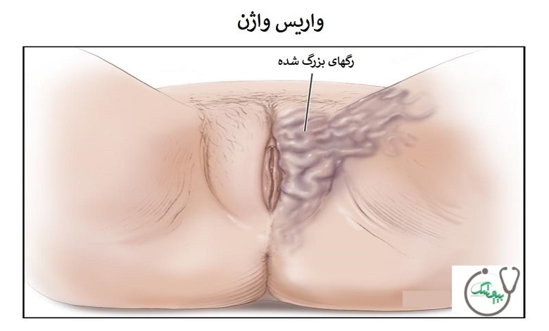 واریس واژن
