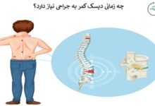 چه موقع دیسک کمر احتیاج به عمل دارد