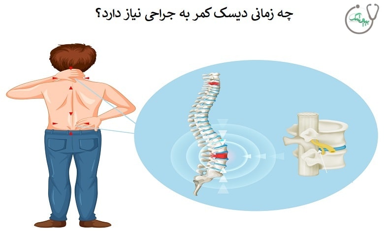 چه موقع دیسک کمر احتیاج به عمل دارد